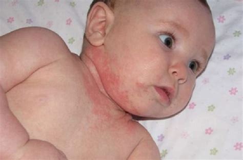 dermatitis en bebes
